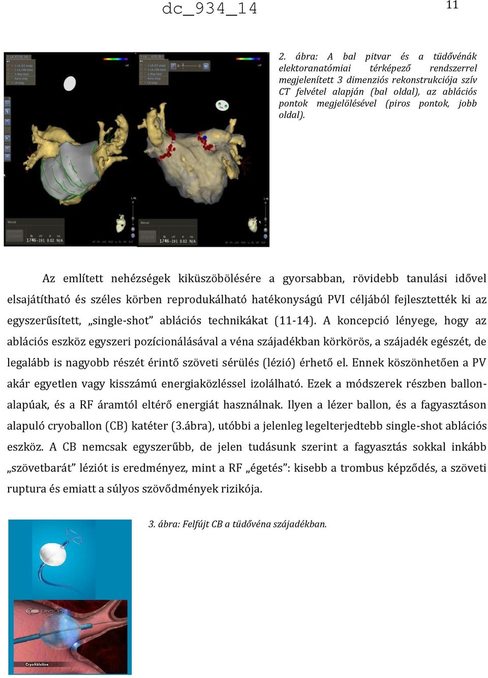 Az említett nehézségek kiküszöbölésére a gyorsabban, rövidebb tanulási idővel elsajátítható és széles körben reprodukálható hatékonyságú PVI céljából fejlesztették ki az egyszerűsített, single-shot