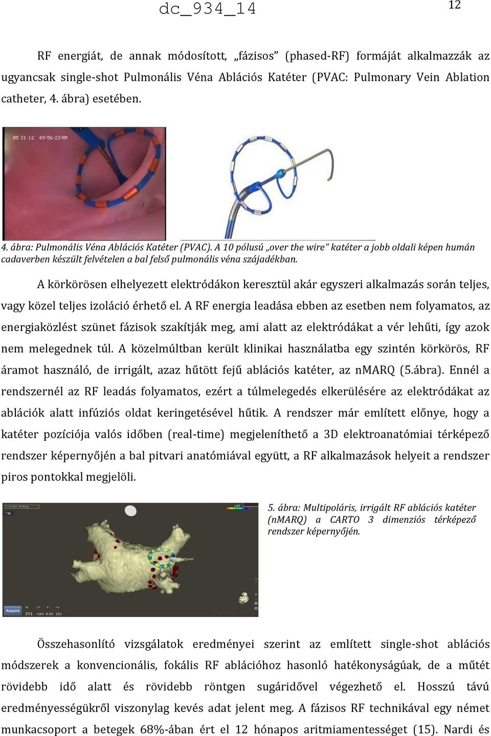 A körkörösen elhelyezett elektródákon keresztül akár egyszeri alkalmazás során teljes, vagy közel teljes izoláció érhető el.