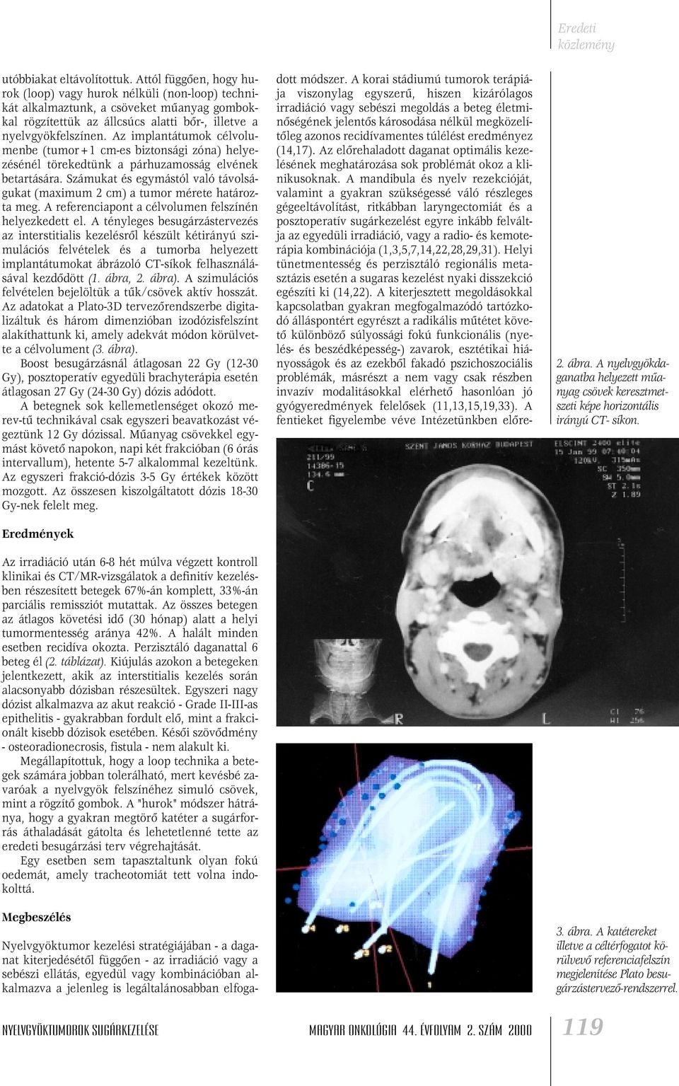 Az implantátumok célvolumenbe (tumor+1 cm-es biztonsági zóna) helyezésénél törekedtünk a párhuzamosság elvének betartására.