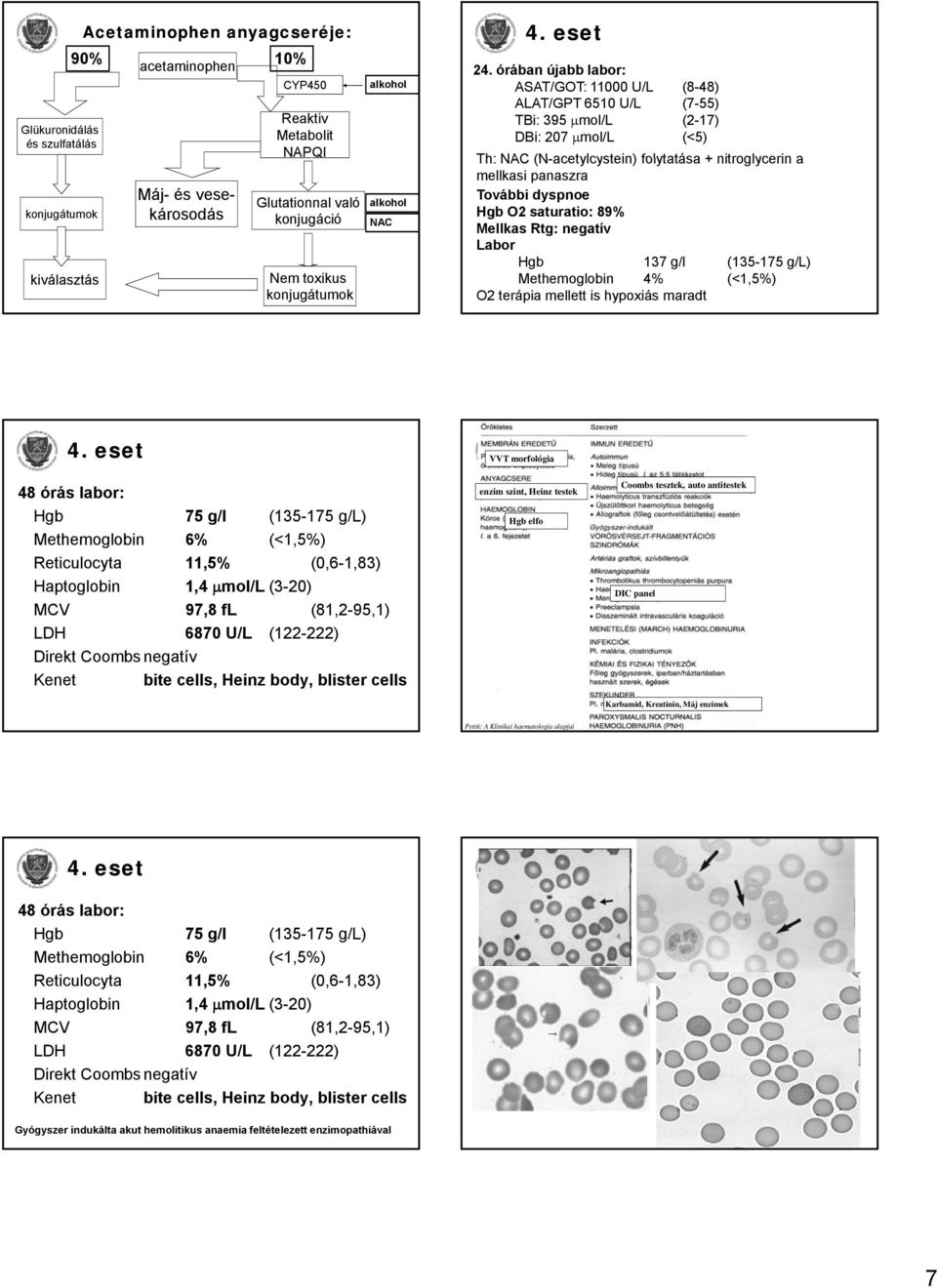 órában újabb labor: ASAT/GOT: 11000 U/L (8-48) ALAT/GPT 6510 U/L (7-55) TBi: 395 μmol/l (2-17) DBi: 207 μmol/l (<5) Th: NAC (N-acetylcystein) folytatása + nitroglycerin a mellkasi panaszra További