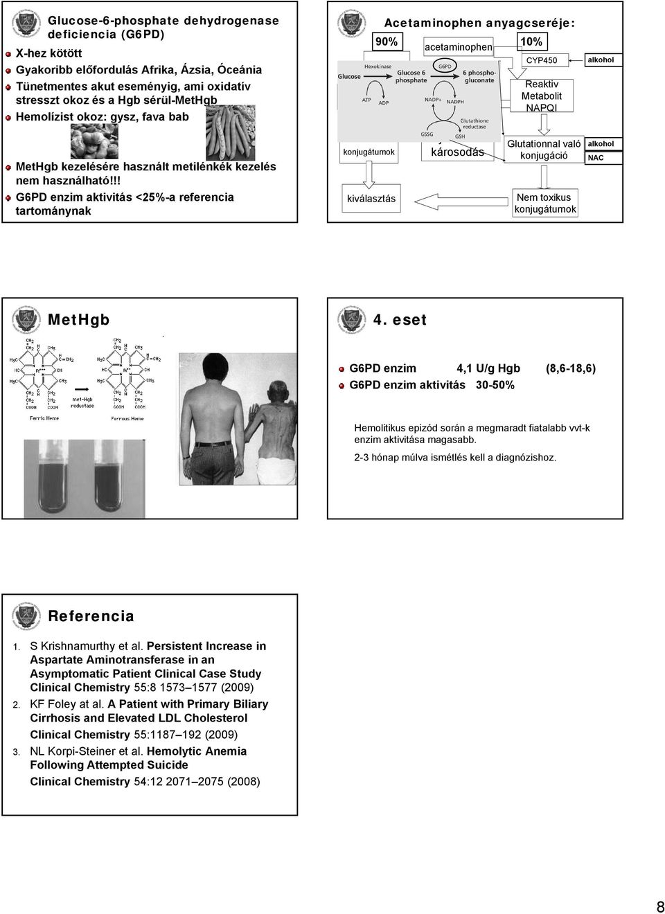 !! G6PD enzim aktivitás <25%-a referencia tartománynak Glükuronidálás és szulfatálás konjugátumok Acetaminophen anyagcseréje: 90% 10% acetaminophen kiválasztás Máj- és vesekárosodás CYP450 Reaktiv