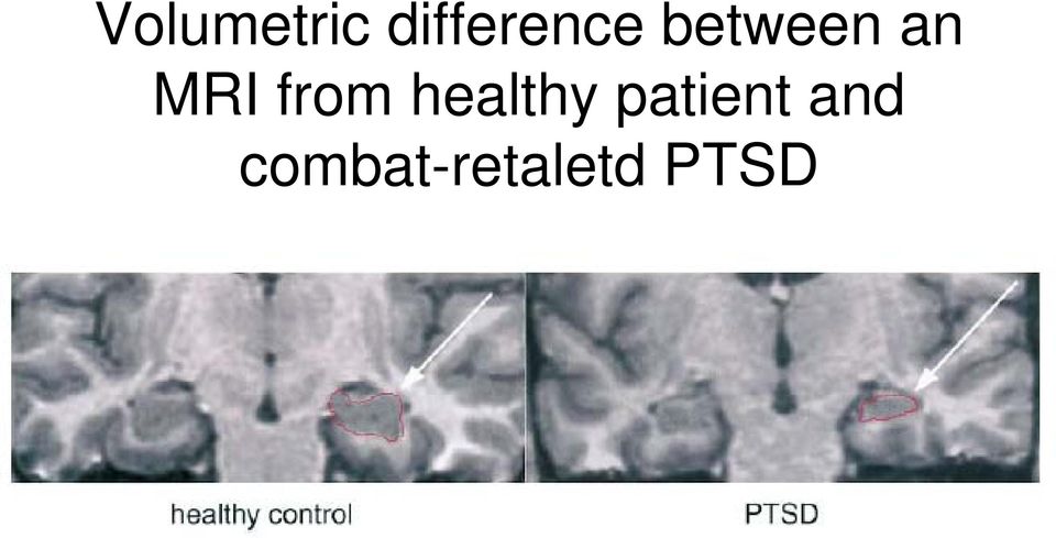 an MRI from healthy