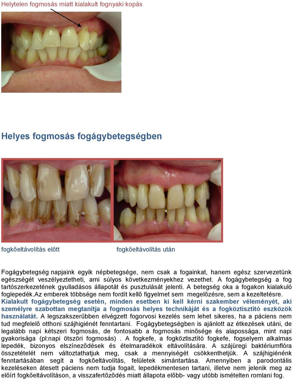 A betegség oka a fogakon kialakuló foglepedék.az emberek többsége nem fordít kellő figyelmet sem megelőzésre, sem a kezeltetésre.