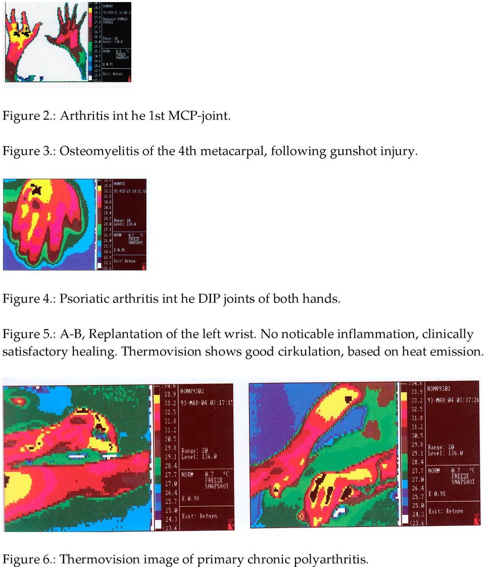 : Psoriatic arthritis int he DIP joints of both hands. Figure 5.: A-B, Replantation of the left wrist.