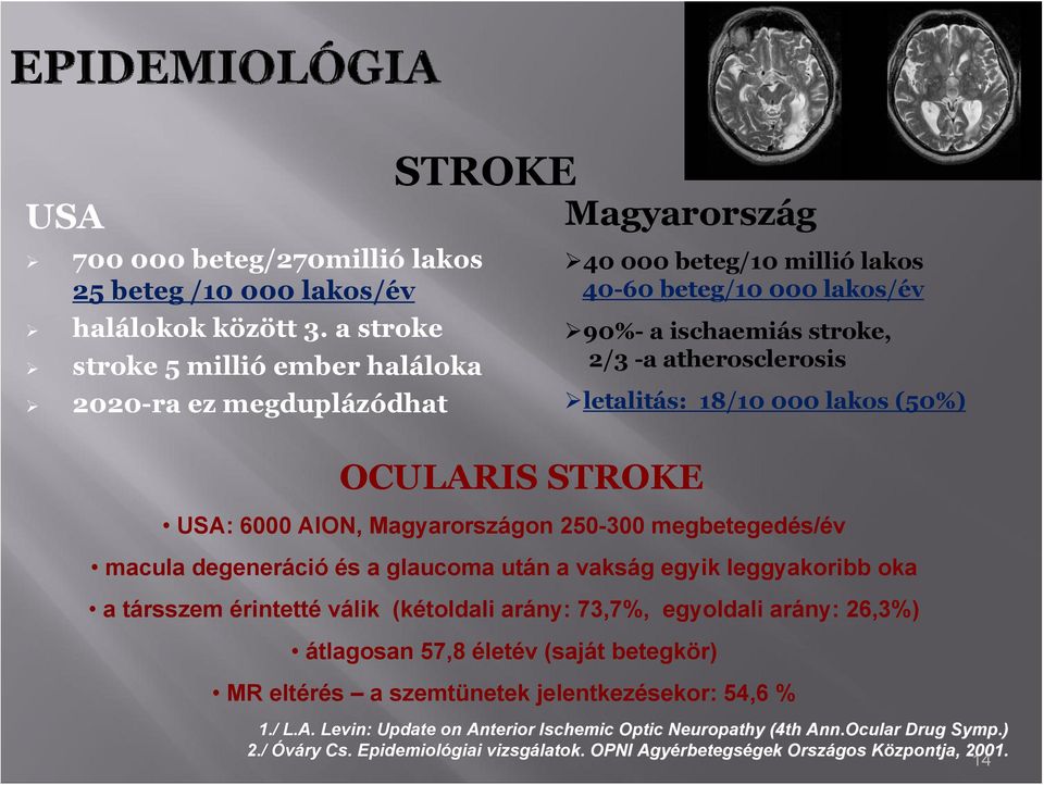 000 laks (50%) OCULARIS STROKE USA: 6000 AION, Magyarrszágn 250-300 megbetegedés/év macula degeneráció és a glaucma után a vakság egyik leggyakribb ka a társszem érintetté válik (kétldali