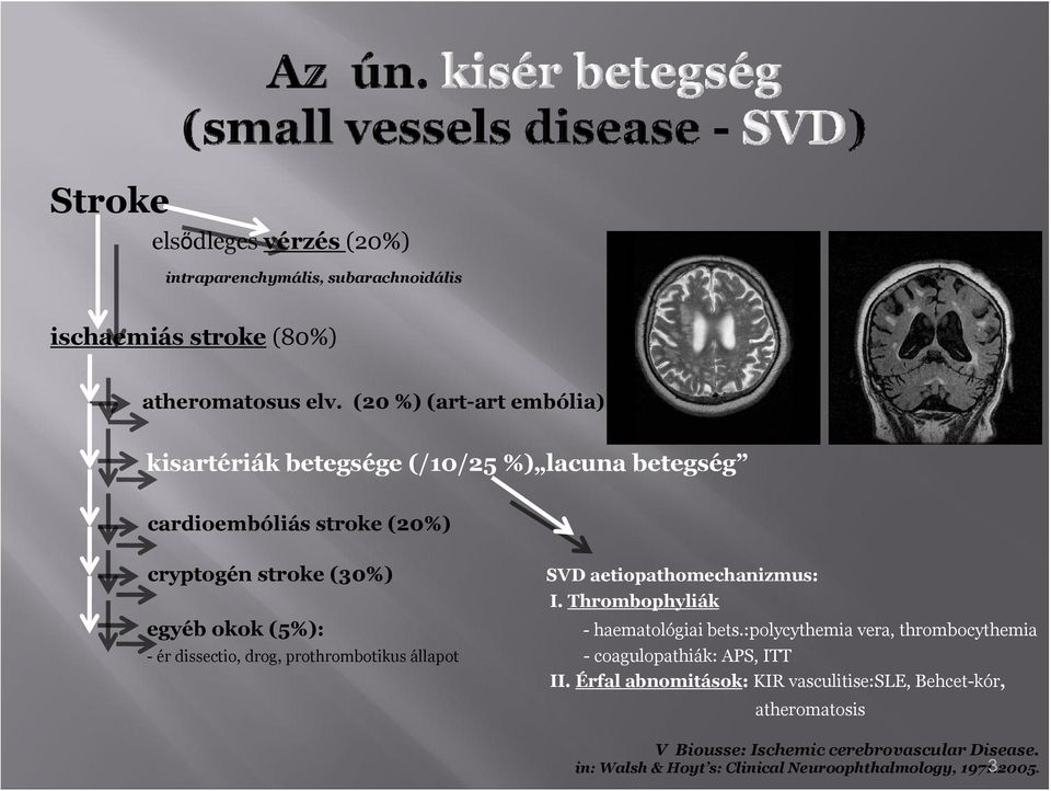 aetipathmechanizmus: I. Thrmbphyliák egyéb kk (5%): - haematlógiai bets.