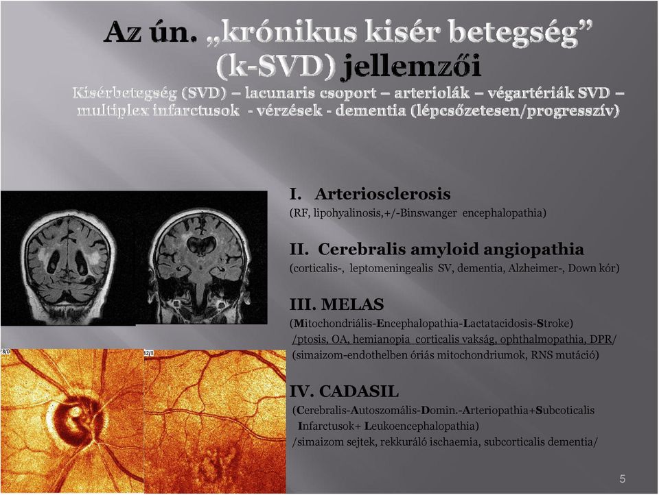 MELAS (Mitchndriális-Encephalpathia-Lactatacidsis-Strke) /ptsis, OA, hemianpia crticalis vakság, phthalmpathia, DPR/