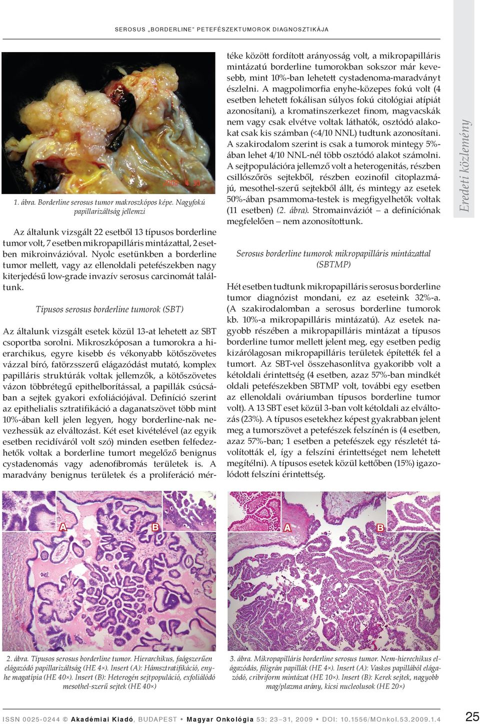 Nyolc esetünkben a borderline tumor melle, vagy az ellenoldali petefészekben nagy kiterjedésű low-grade invazív serosus carcinomát találtunk.