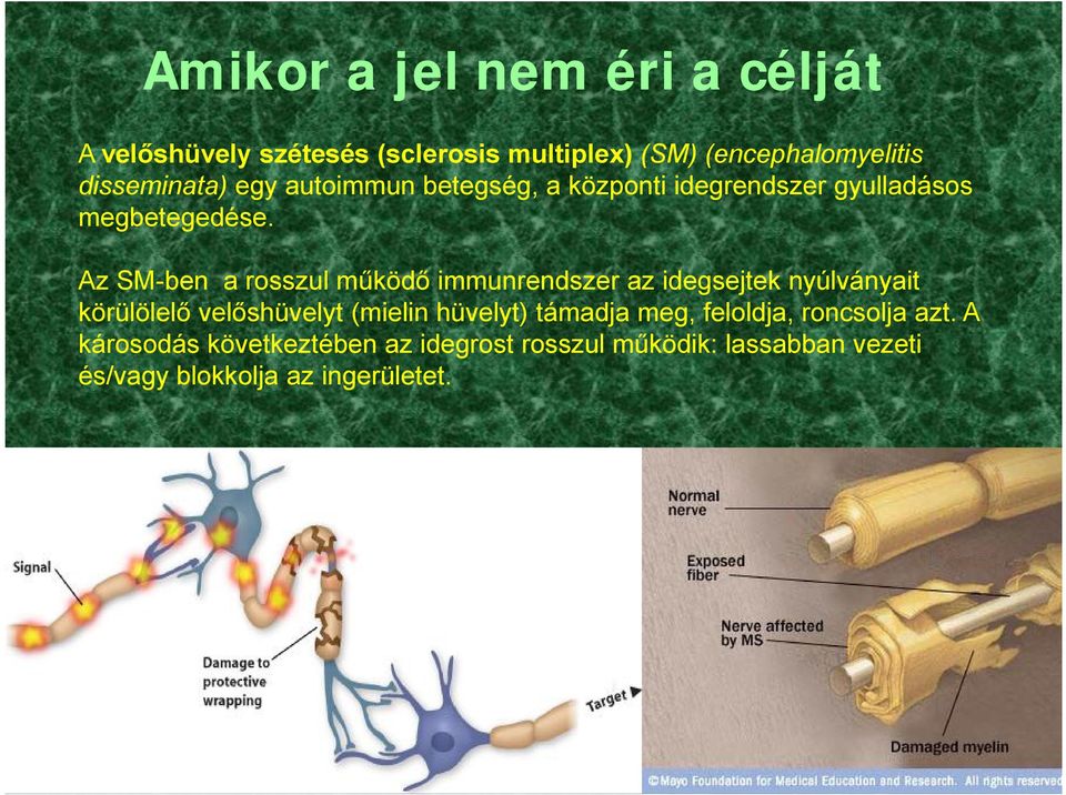 Az SM-ben a rosszul működő immunrendszer az idegsejtek nyúlványait körülölelő velőshüvelyt (mielin hüvelyt)