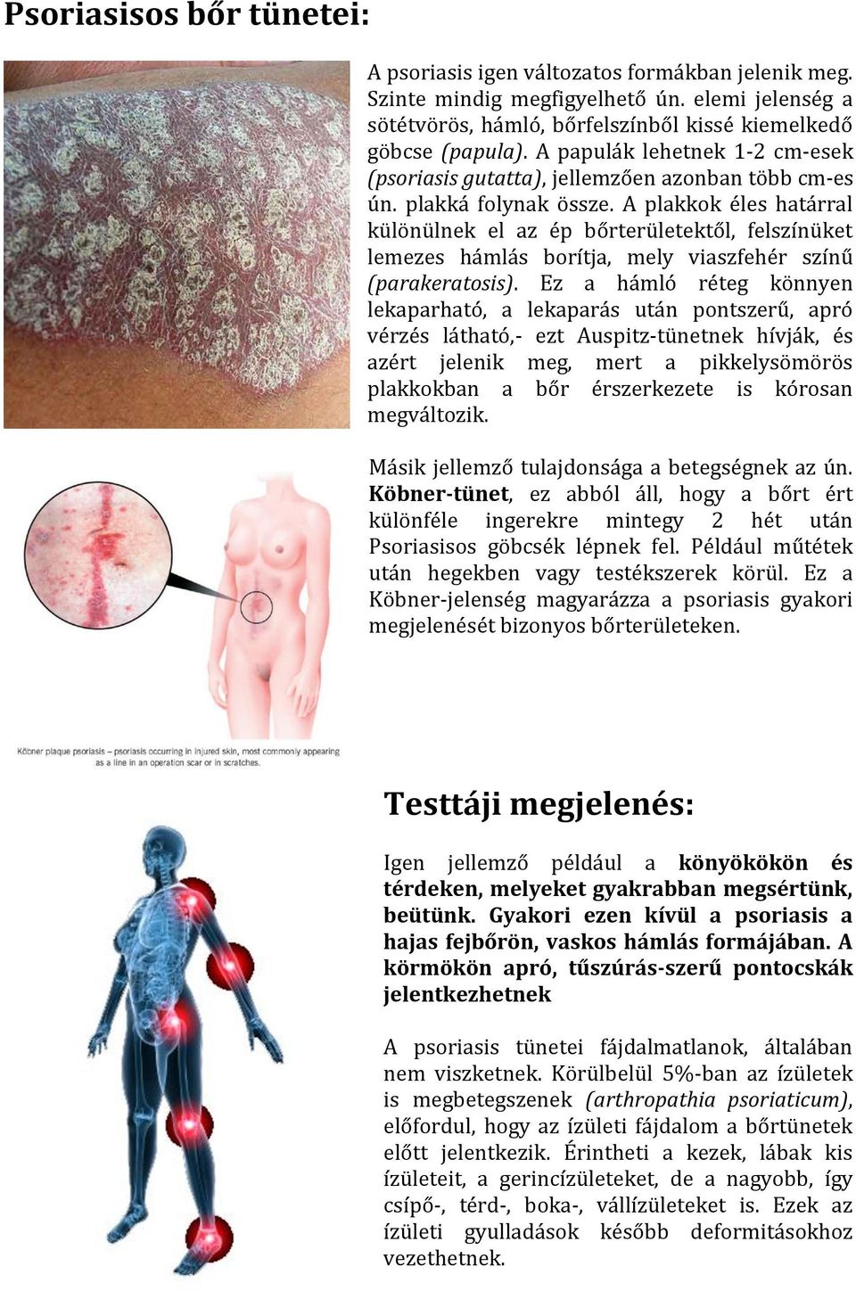 A plakkok éles határral különülnek el az ép bőrterületektől, felszínüket lemezes hámlás borítja, mely viaszfehér színű (parakeratosis).