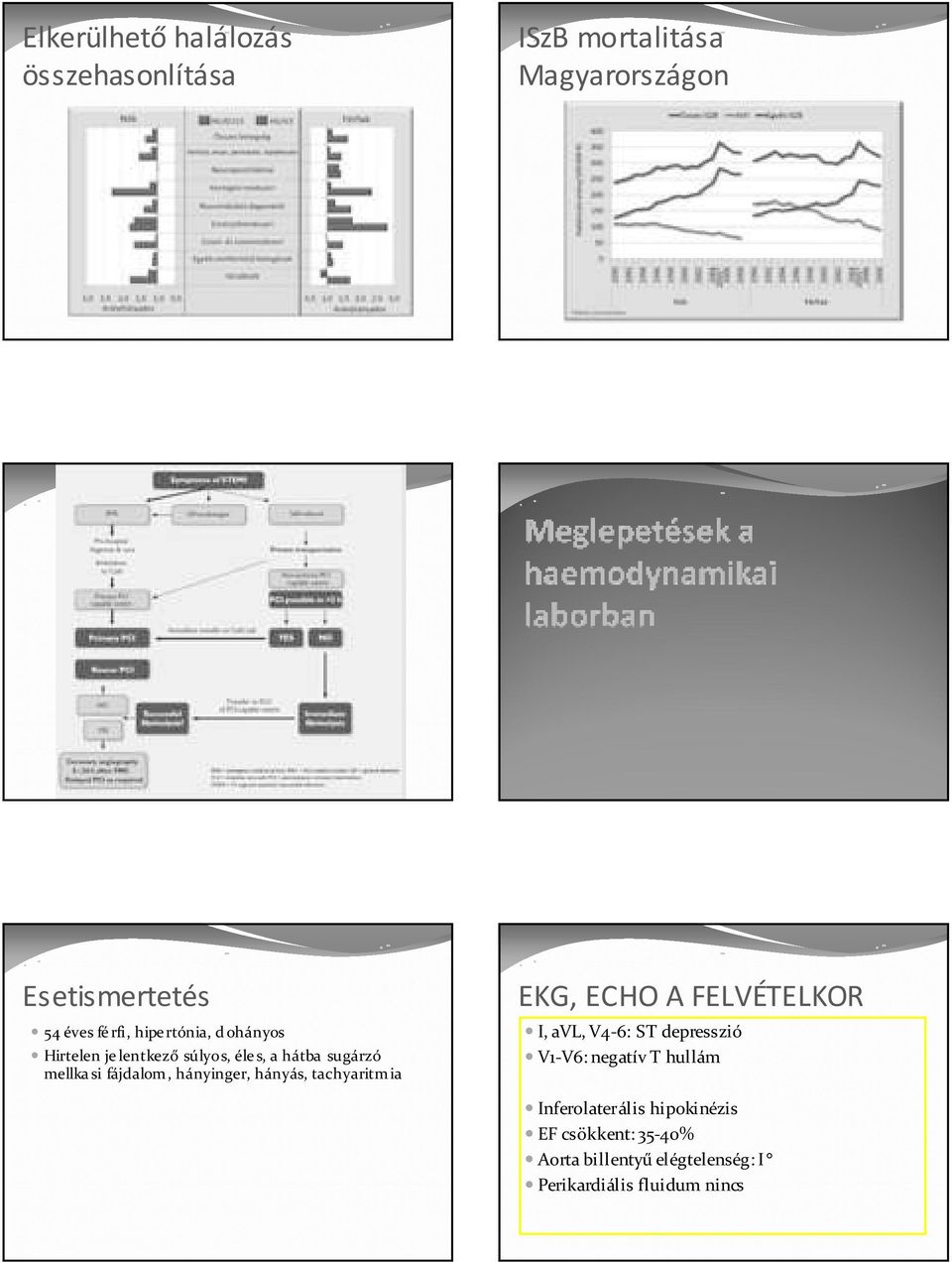 hányás, tachyaritm ia EKG, ECHO A FELVÉTELKOR I, avl, V4-6: ST depresszió V1-V6: negatív T hullám