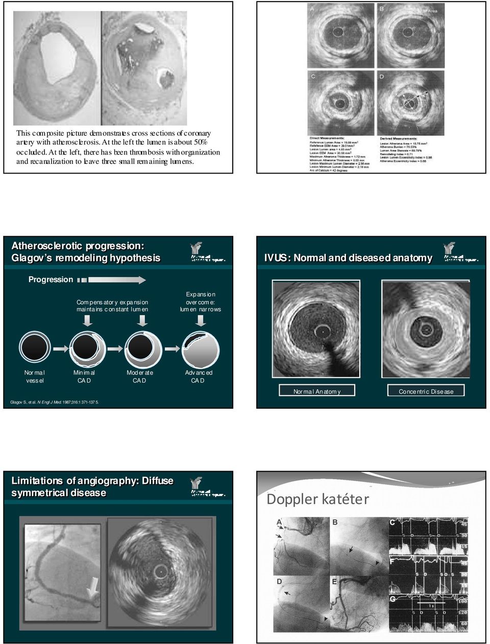 Atherosclerotic progression: Glagov s remodeling hypothesis Progression Com pens ator y ex pansion maintains c onstant lum en Expans ion over com e: lum en nar rows IVUS: Normal and