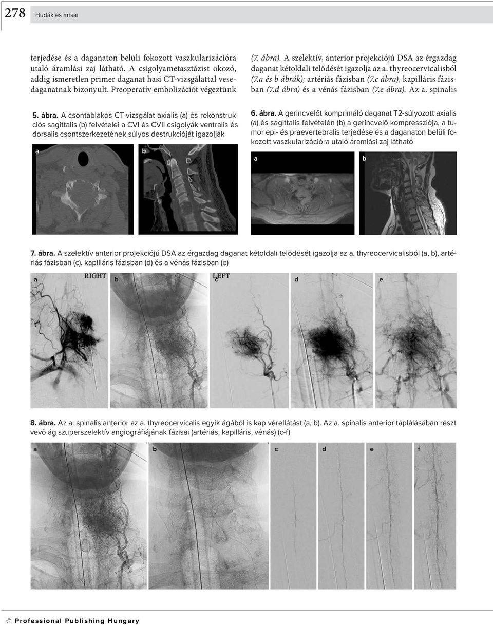 d ár) és vénás fázisn (7.e ár). Az. spinlis 5. ár. A csontlkos CT-vizsgált xilis () és rekonstrukciós sgittlis () felvételei CVI és CVII csigolyák ventrlis és dorslis csontszerkezetének súlyos destrukcióját igzolják 6.