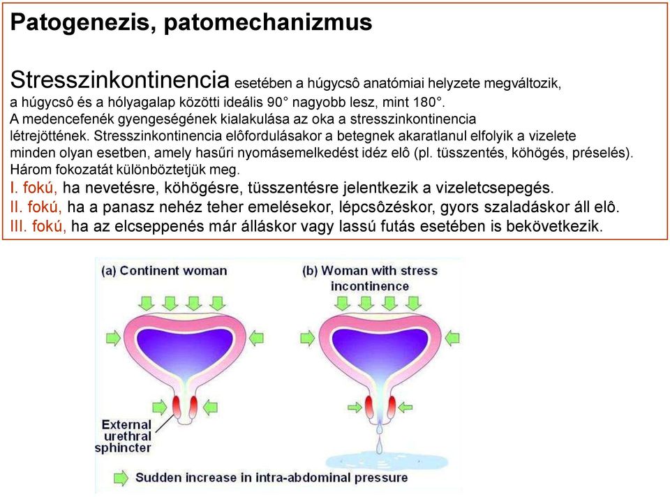 Stresszinkontinencia elôfordulásakor a betegnek akaratlanul elfolyik a vizelete minden olyan esetben, amely hasűri nyomásemelkedést idéz elô (pl. tüsszentés, köhögés, préselés).