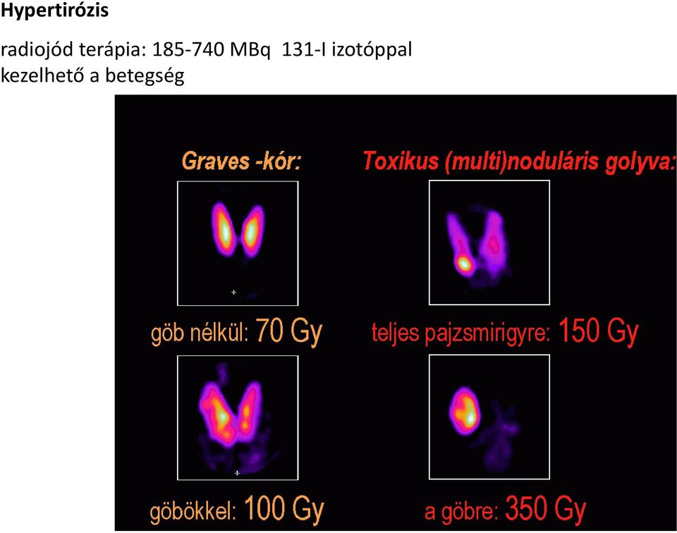 185-740 MBq 131-I