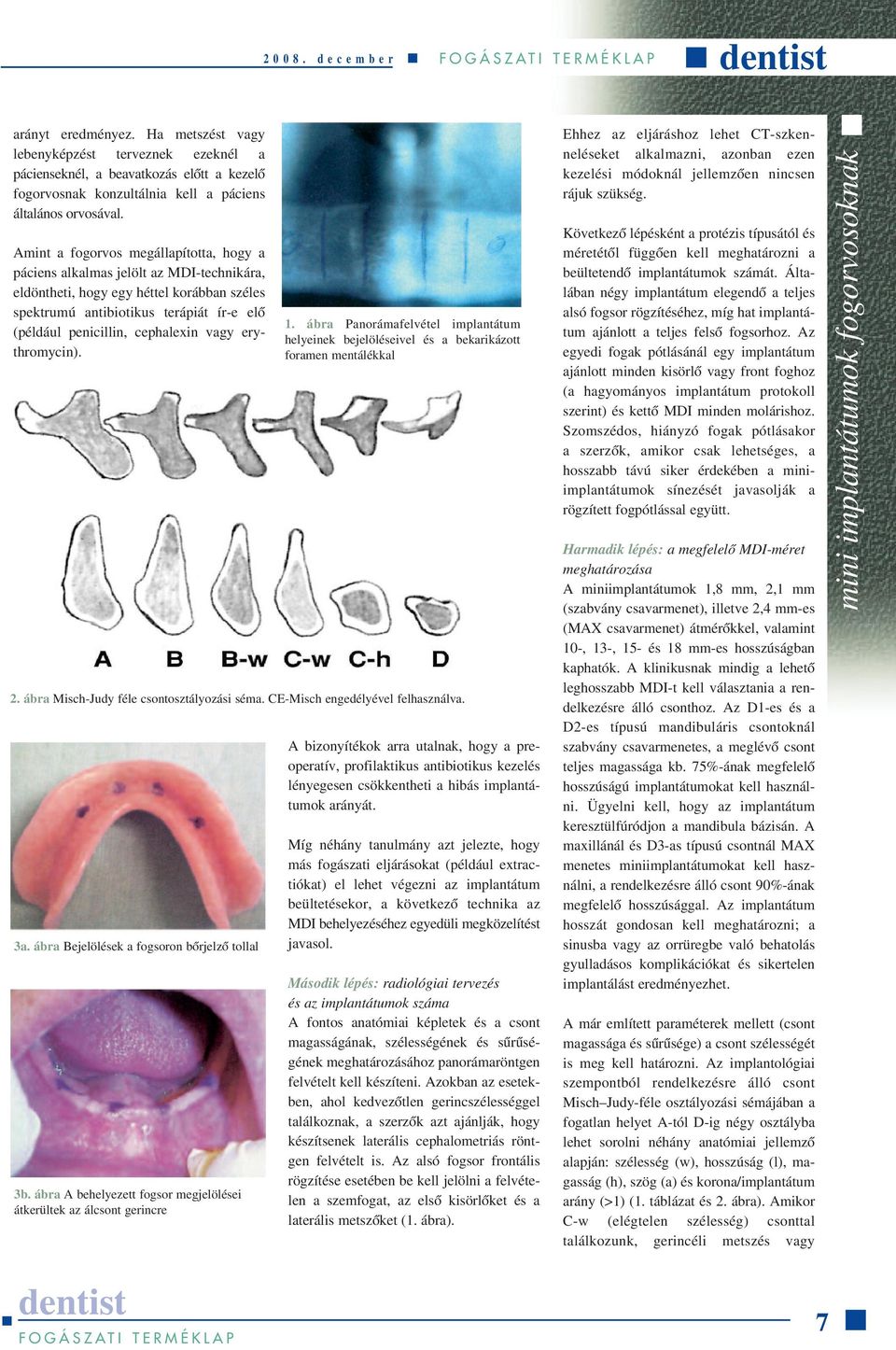 vagy erythromycin). 1. ábra Panorámafelvétel implantátum helyeinek bejelöléseivel és a bekarikázott foramen mentálékkal 2. ábra Misch-Judy féle csontosztályozási séma.