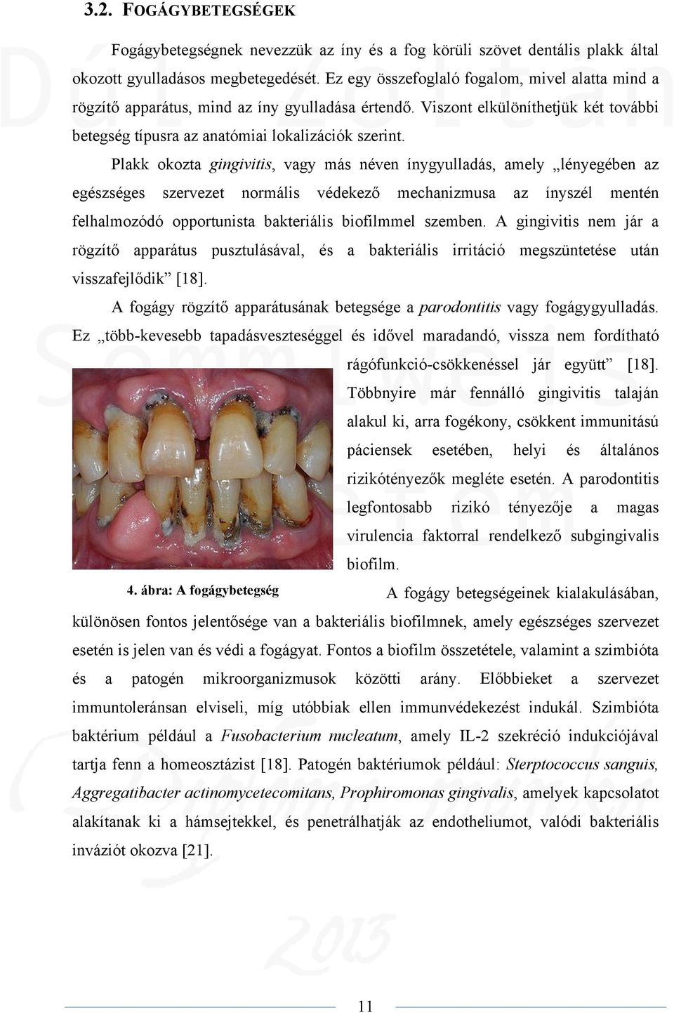 Plakk okozta gingivitis, vagy más néven ínygyulladás, amely lényegében az egészséges szervezet normális védekező mechanizmusa az ínyszél mentén felhalmozódó opportunista bakteriális biofilmmel