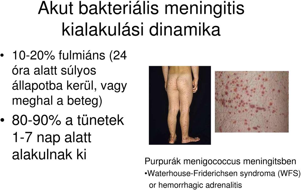 a tünetek 1-7 nap alatt alakulnak ki Purpurák menigococcus