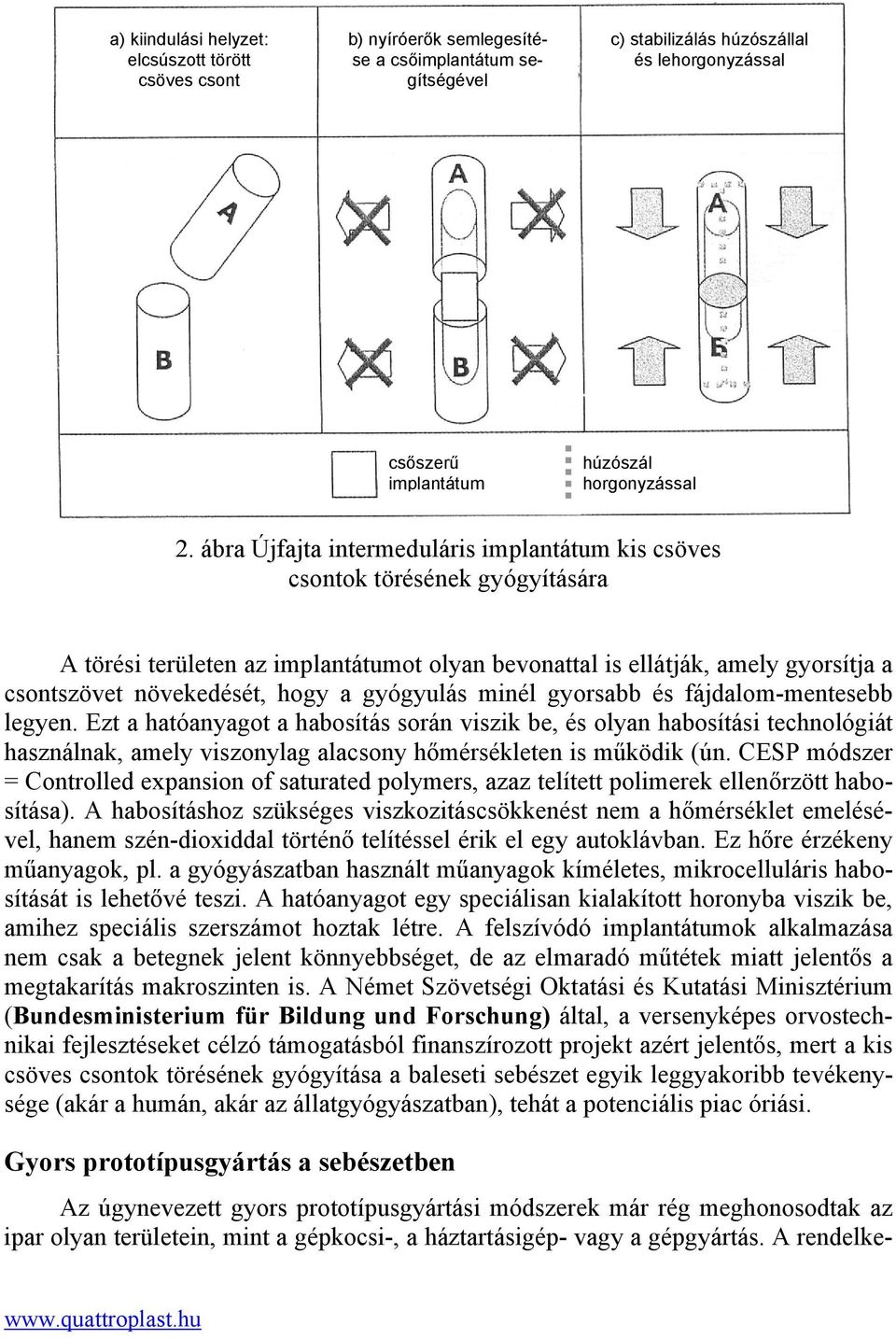 ábra Újfajta intermeduláris implantátum kis csöves csontok törésének gyógyítására A törési területen az implantátumot olyan bevonattal is ellátják, amely gyorsítja a csontszövet növekedését, hogy a