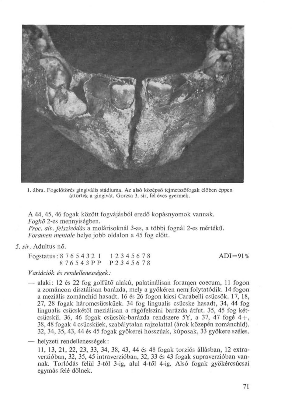 Foramen mentale helye jobb oldalon a 45 fog előtt. 5. sír, Aduitus nő.