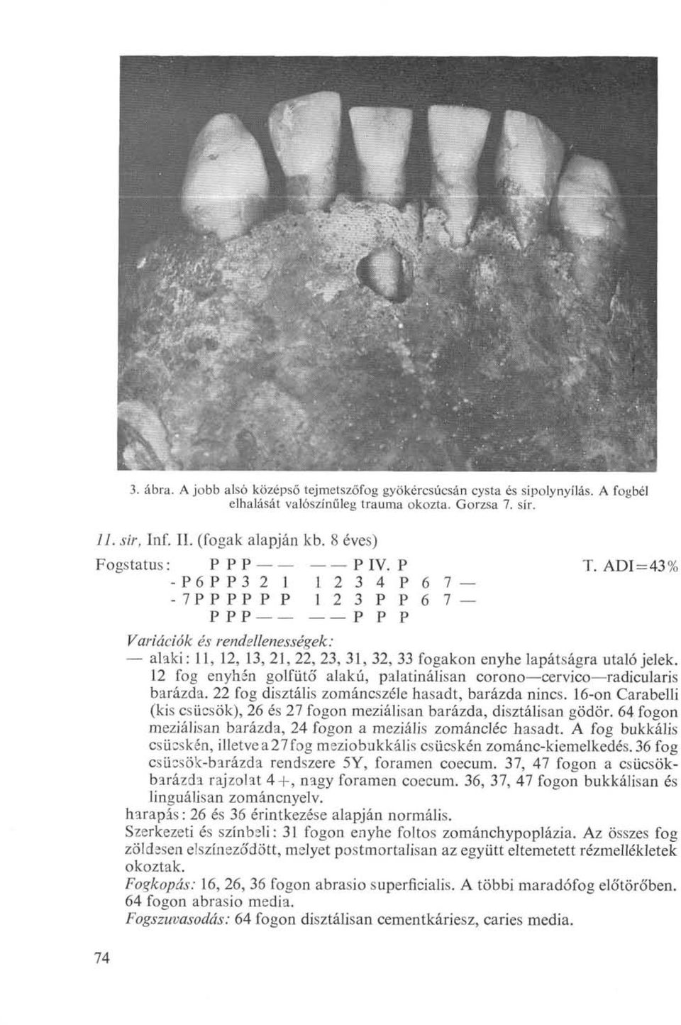 12 fog enyhén golfütő alakú, palatinálisan corono cervico radicularis barázda. 22 fog disztális zománcszéle hasadt, barázda nincs.