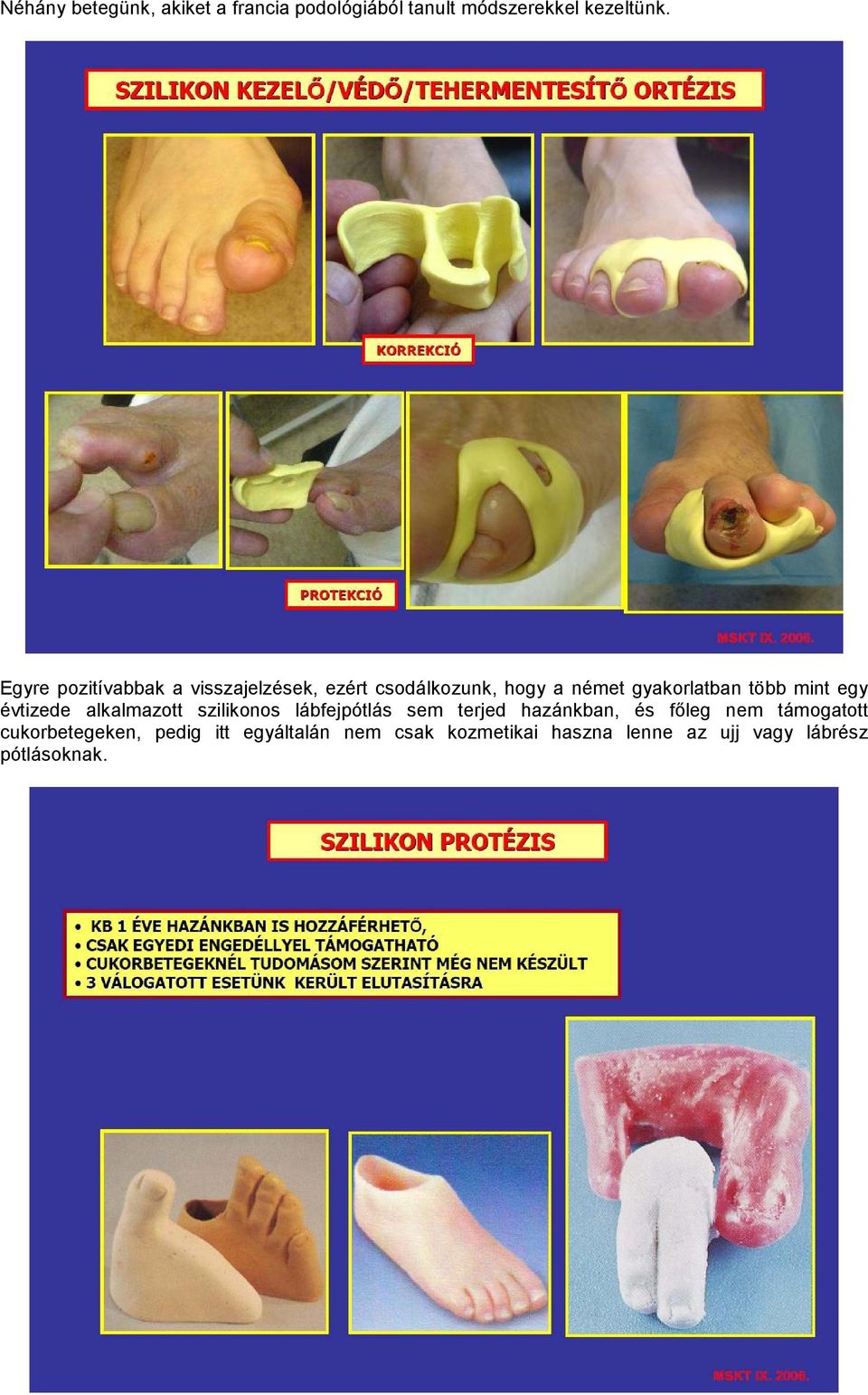 mint egy évtizede alkalmazott szilikonos lábfejpótlás sem terjed hazánkban, és főleg nem