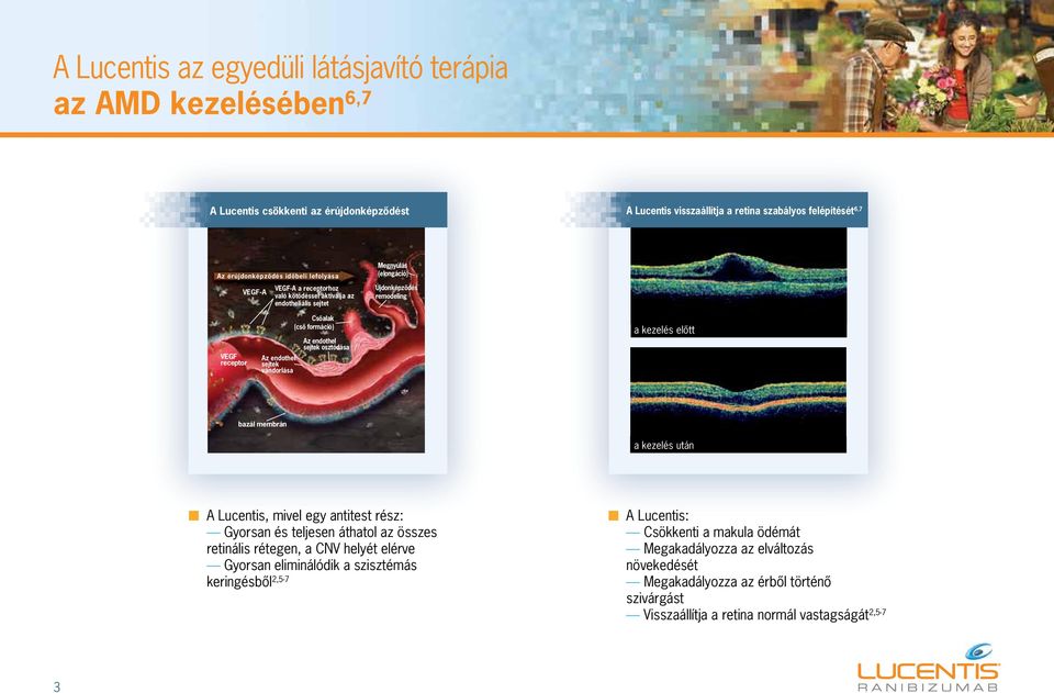 osztódása Az endothel sejtek vándorlása a kezelés elôtt bazál membrán a kezelés után n A Lucentis, mivel egy antitest rész: Gyorsan és teljesen áthatol az összes retinális rétegen, a CNV helyét