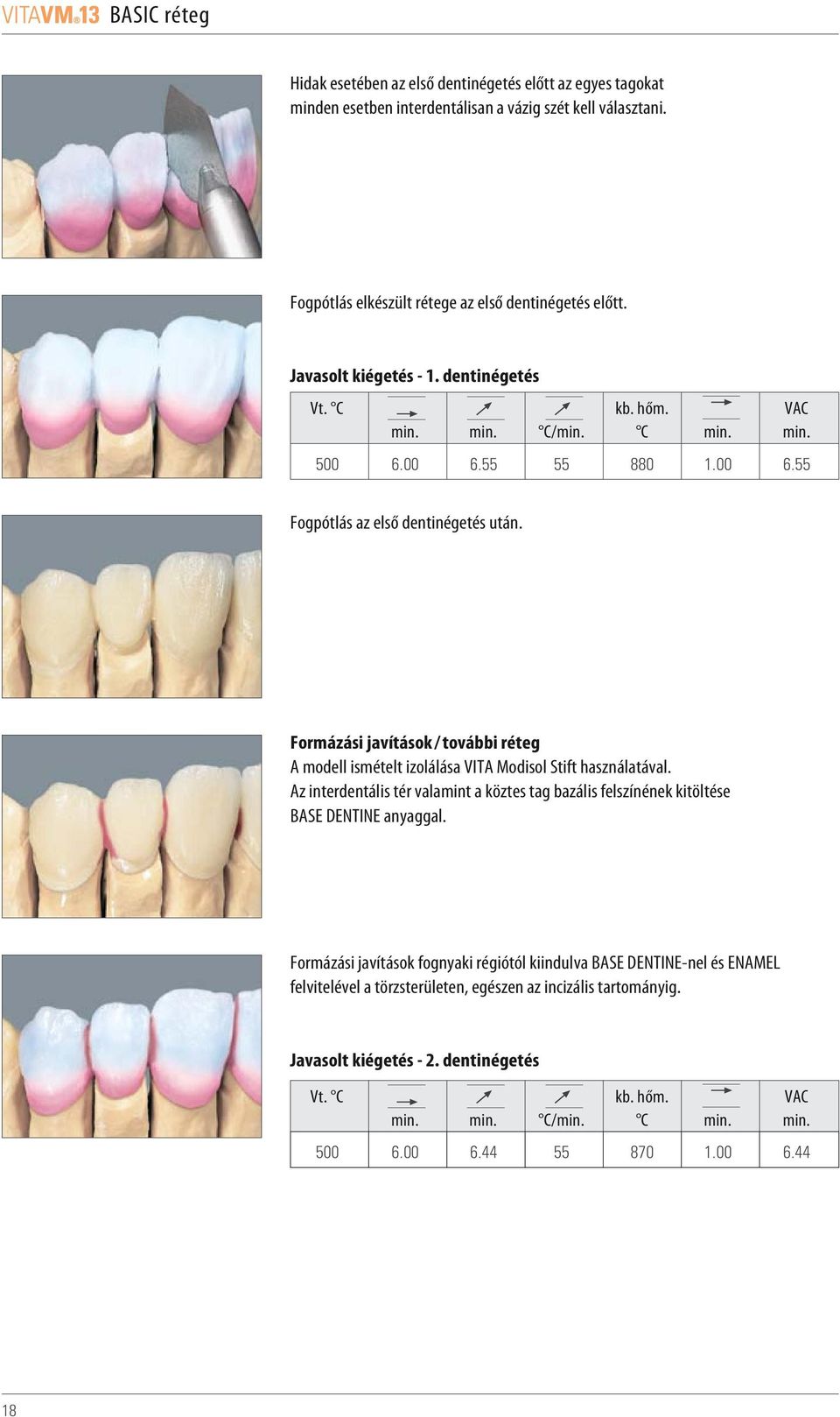 Formázási javítások / további réteg A modell ismételt izolálása VITA Modisol Stift használatával. Az interdentális tér valamint a köztes tag bazális felszínének kitöltése BASE DENTINE anyaggal.