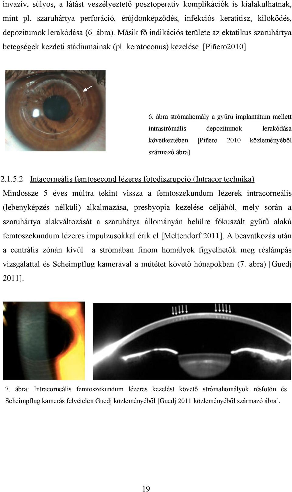 ábra strómahomály a gyűrű implantátum mellett intrastrómális depozitumok lerakódása következtében [Piñero 2010 közleményéből származó ábra] 2.1.5.