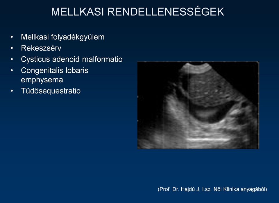 malformatio Congenitalis lobaris emphysema