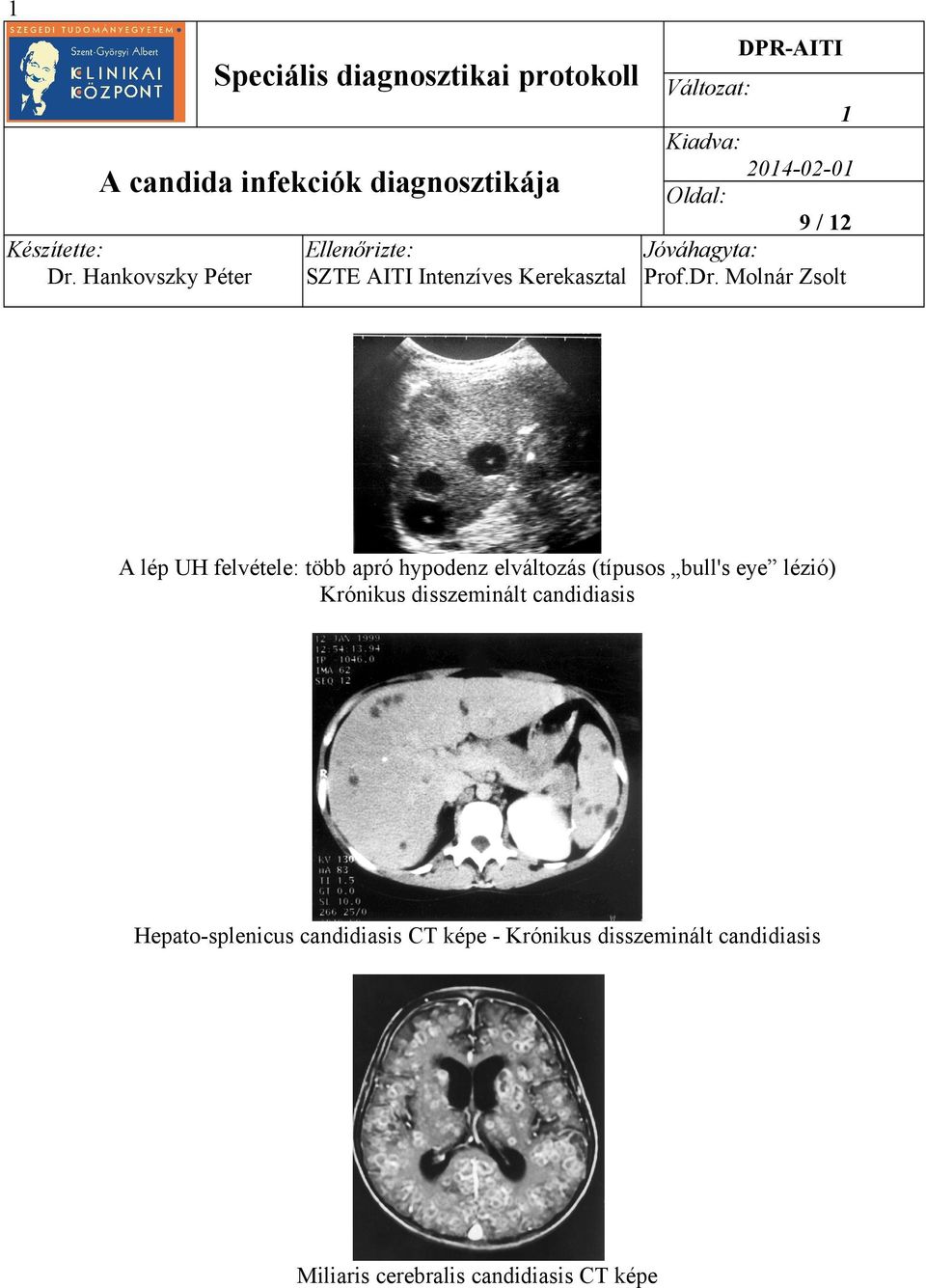 candidiasis Hepato-splenicus candidiasis CT képe - Krónikus