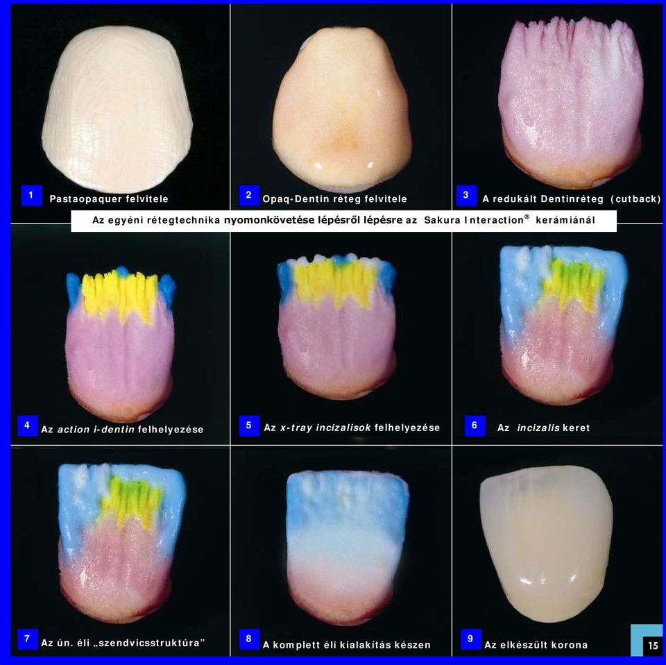 4 Az action i-dentin felhelyezése 5 Az x-tray incizalisok felhelyezése 6 Az incizalis