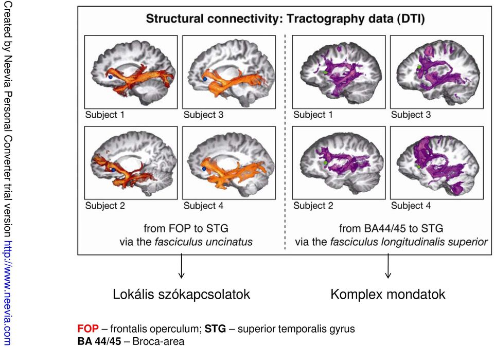 gyrus BA 44/45 Broca-area Created by Neevia