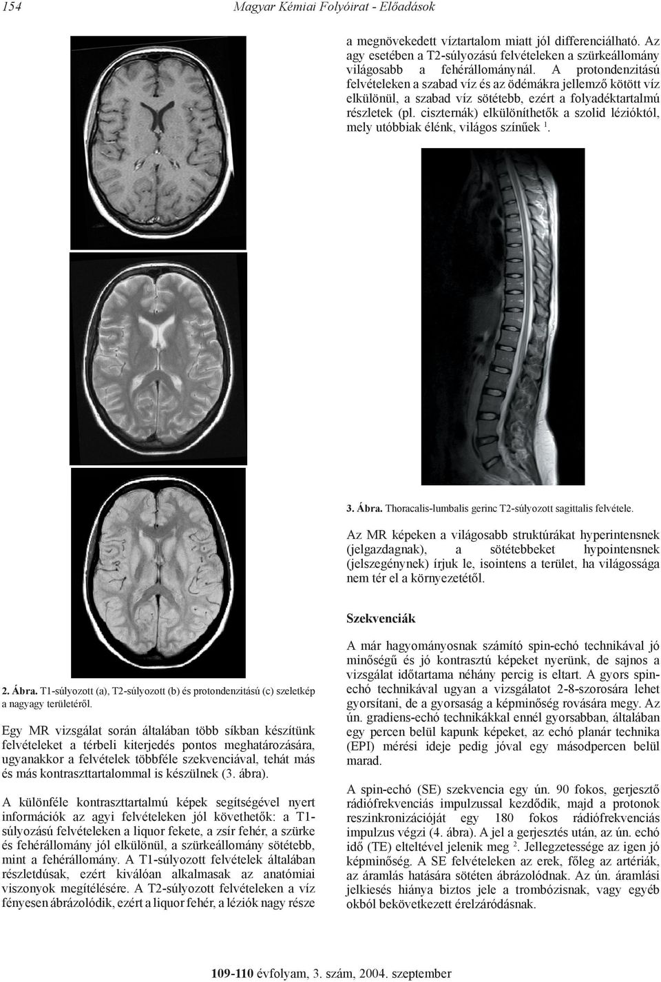 ciszternák) elkülöníthetők a szolid lézióktól, mely utóbbiak élénk, világos színűek 1. 3. Ábra. Thoracalis-lumbalis gerinc T2-súlyozott sagittalis felvétele.