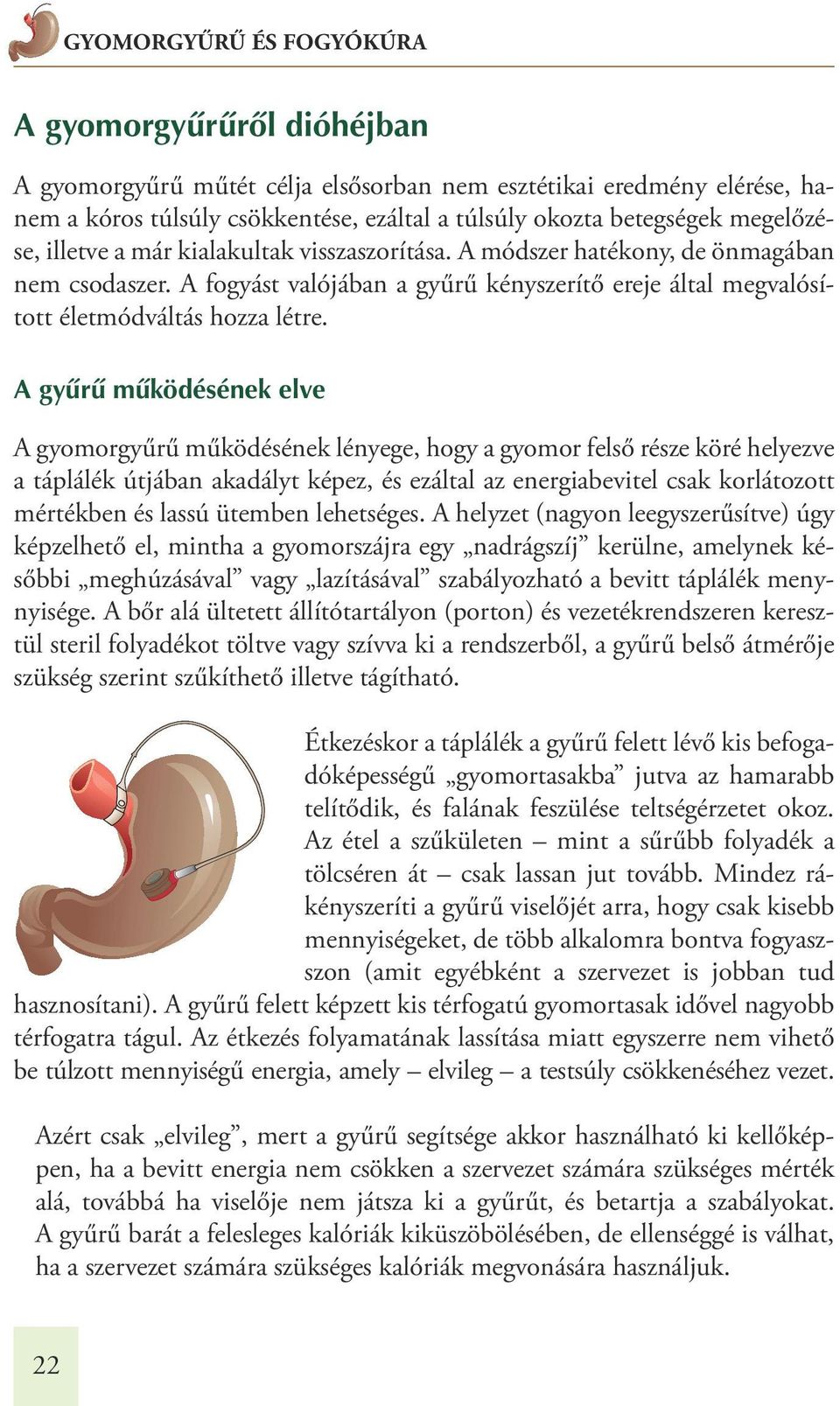 A gyûrû mûködésének elve A gyomorgyűrű működésének lényege, hogy a gyomor felső része köré helyezve a táplálék útjában akadályt képez, és ezáltal az energiabevitel csak korlátozott mértékben és lassú