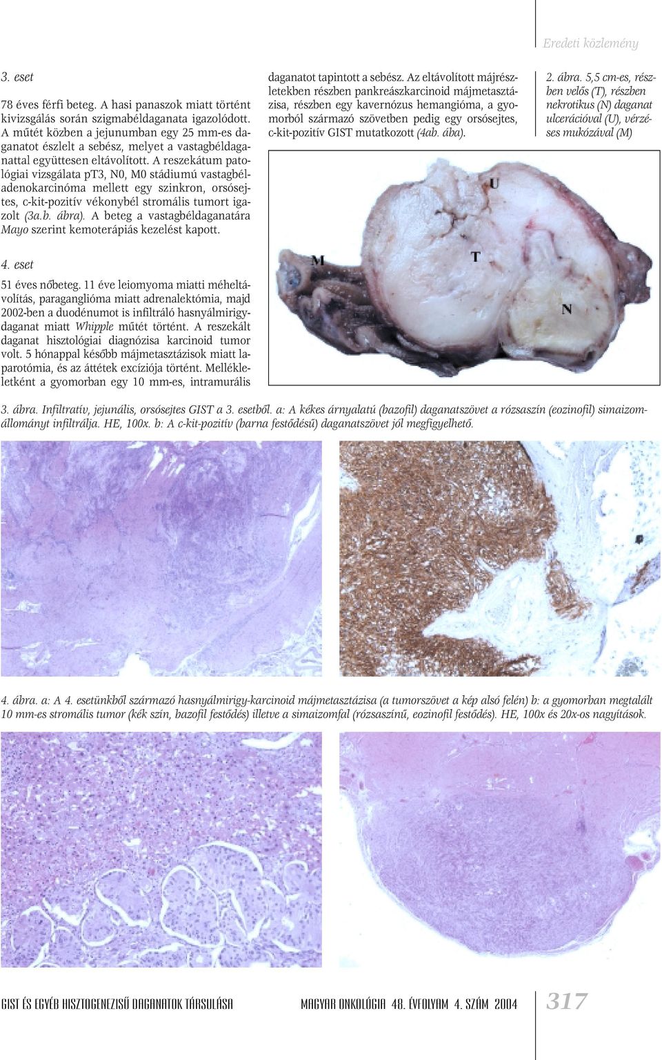 A reszekátum patológiai vizsgálata pt3, N0, M0 stádiumú vastagbéladenokarcinóma mellett egy szinkron, orsósejtes, c-kit-pozitív vékonybél stromális tumort igazolt (3a.b. ábra).