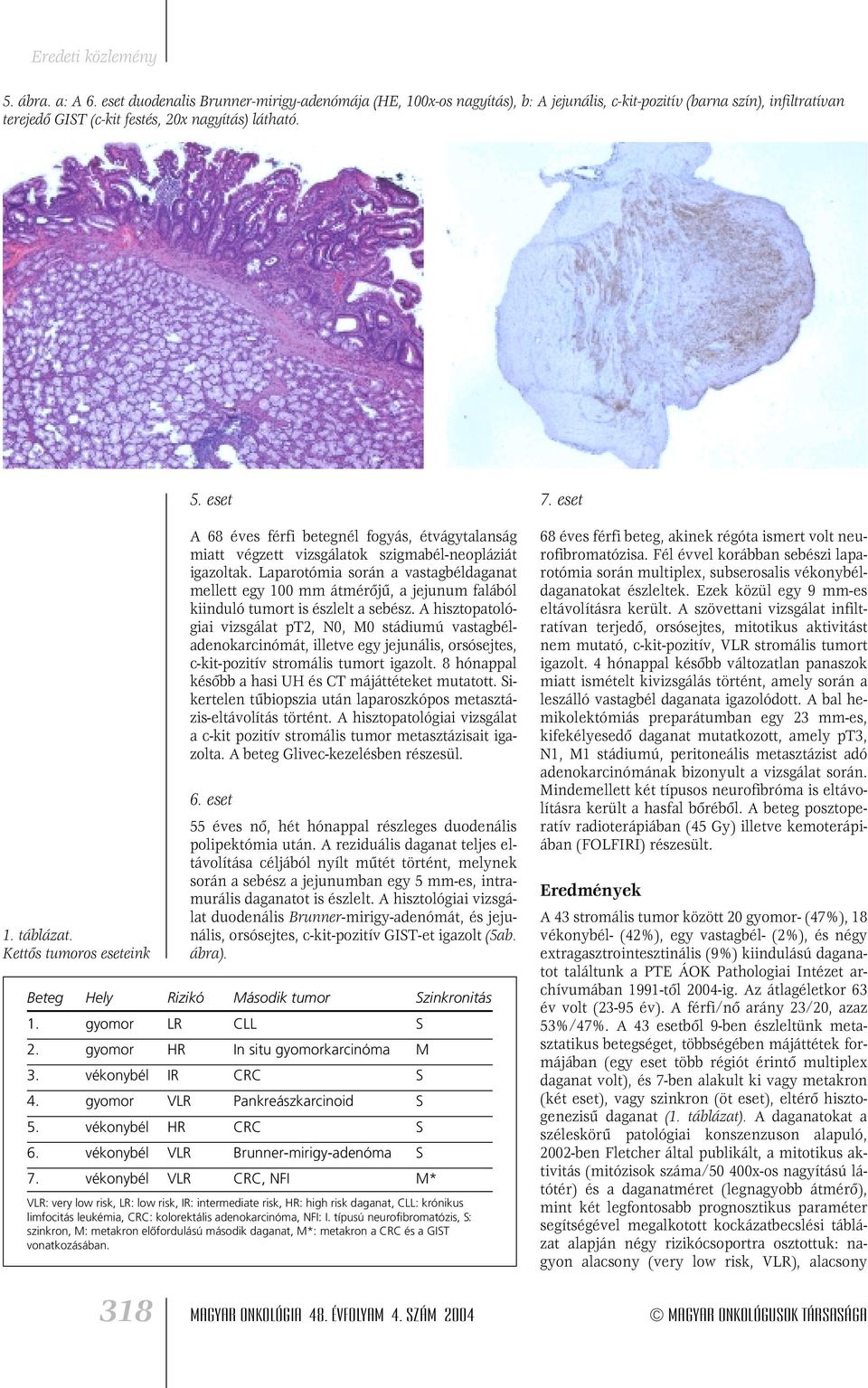 Laparotómia során a vastagbéldaganat mellett egy 100 mm átmérôjû, a jejunum falából kiinduló tumort is észlelt a sebész.