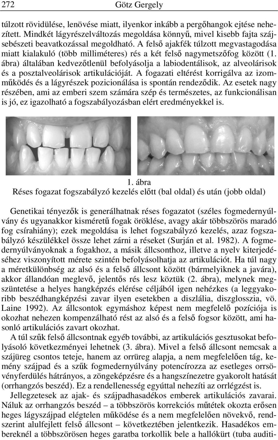 ábra) általában kedvezőtlenül befolyásolja a labiodentálisok, az alveolárisok és a posztalveolárisok artikulációját.