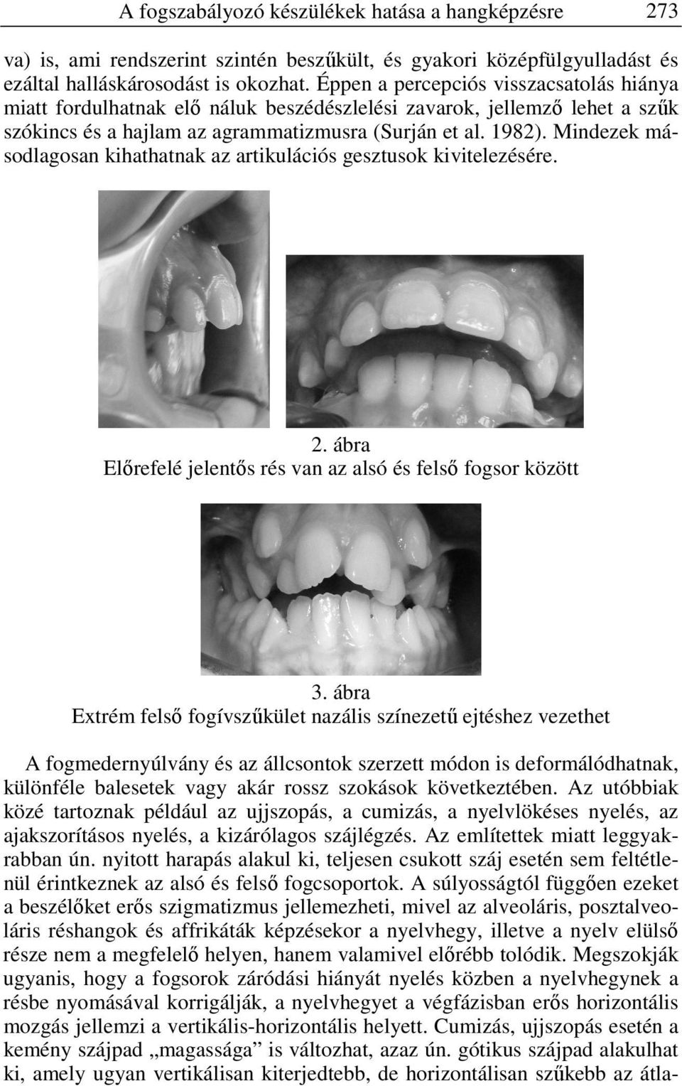 Mindezek másodlagosan kihathatnak az artikulációs gesztusok kivitelezésére. 2. ábra Előrefelé jelentős rés van az alsó és felső fogsor között 3.