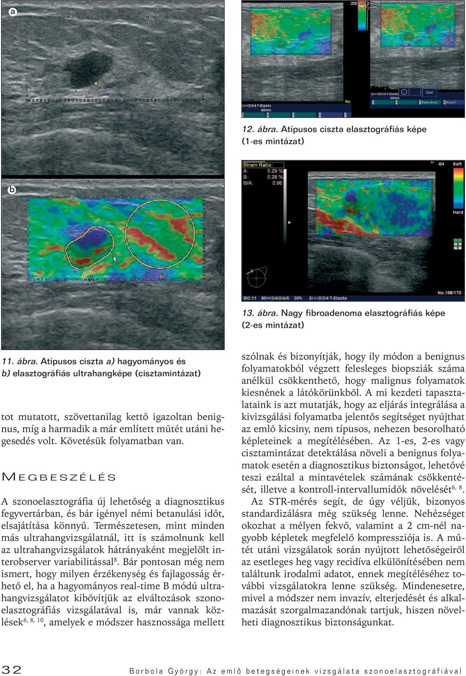 Nagy fibroadenoma elasztográfiás képe (2-es mintázat) 11. ábra.