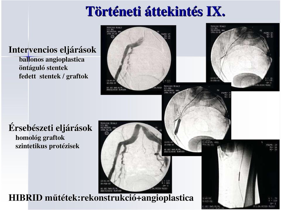 öntáguló stentek fedett stentek / graftok Érsebészeti