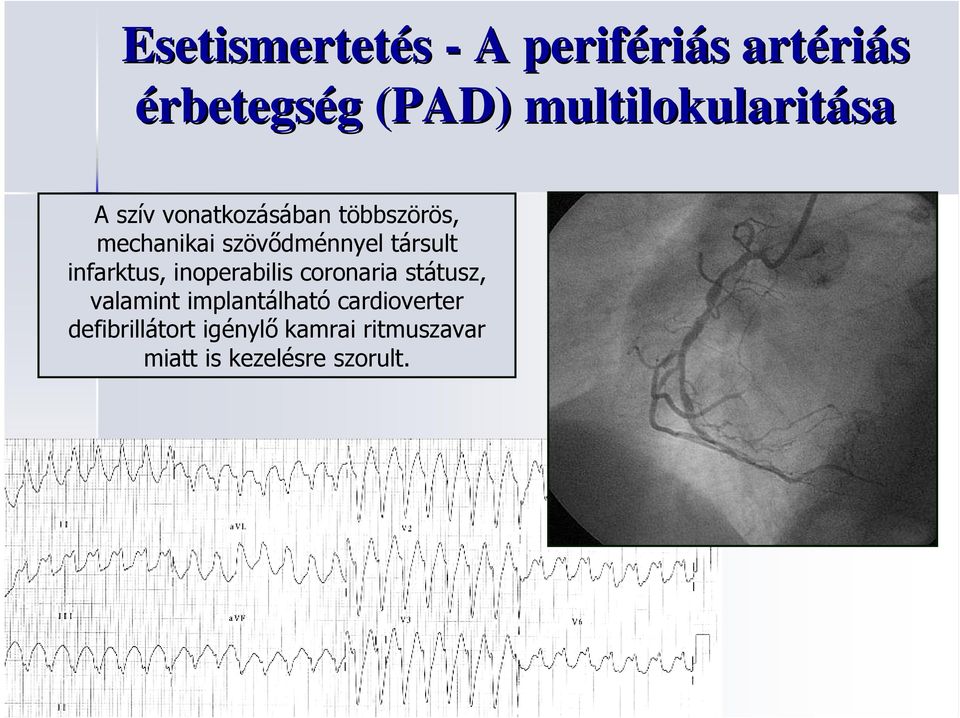 szövıdménnyel társult infarktus, inoperabilis coronaria státusz,