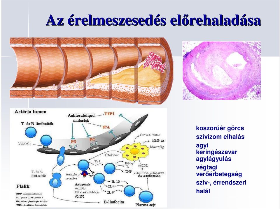 elhalás agyi keringészavar agylágyulás