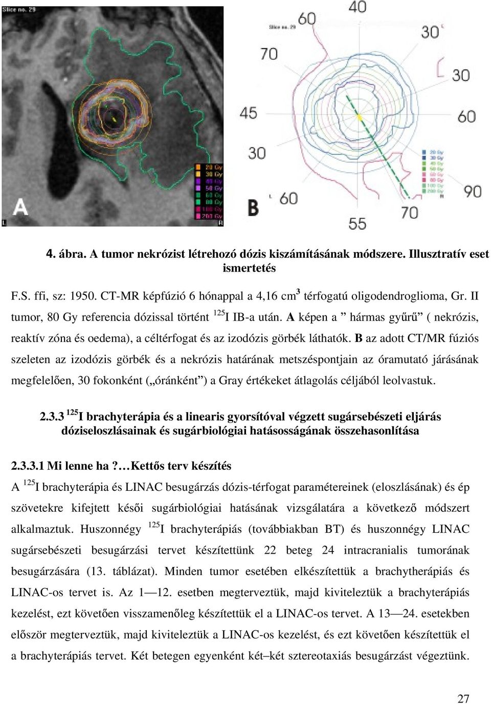 B az adott CT/MR fúziós szeleten az izodózis görbék és a nekrózis határának metszéspontjain az óramutató járásának megfelel en, 30 fokonként ( óránként ) a Gray értékeket átlagolás céljából
