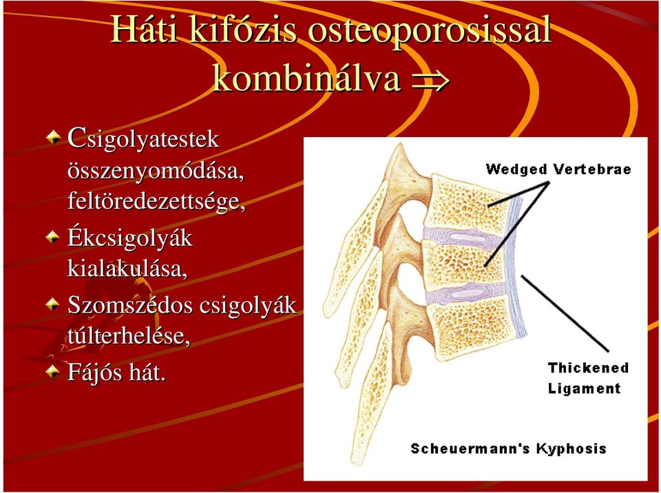 redezettsége, Ékcsigolyák kialakulása,