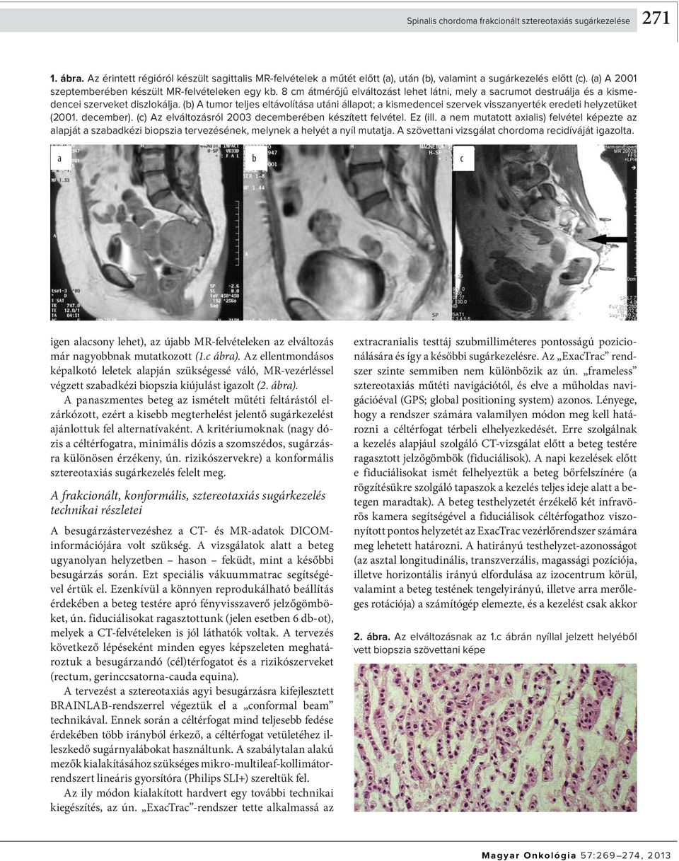 (b) A tumor teljes eltávolítása utáni állapot; a kismedencei szervek visszanyerték eredeti helyzetüket (2001. december). (c) Az elváltozásról 2003 decemberében készített felvétel. Ez (ill.