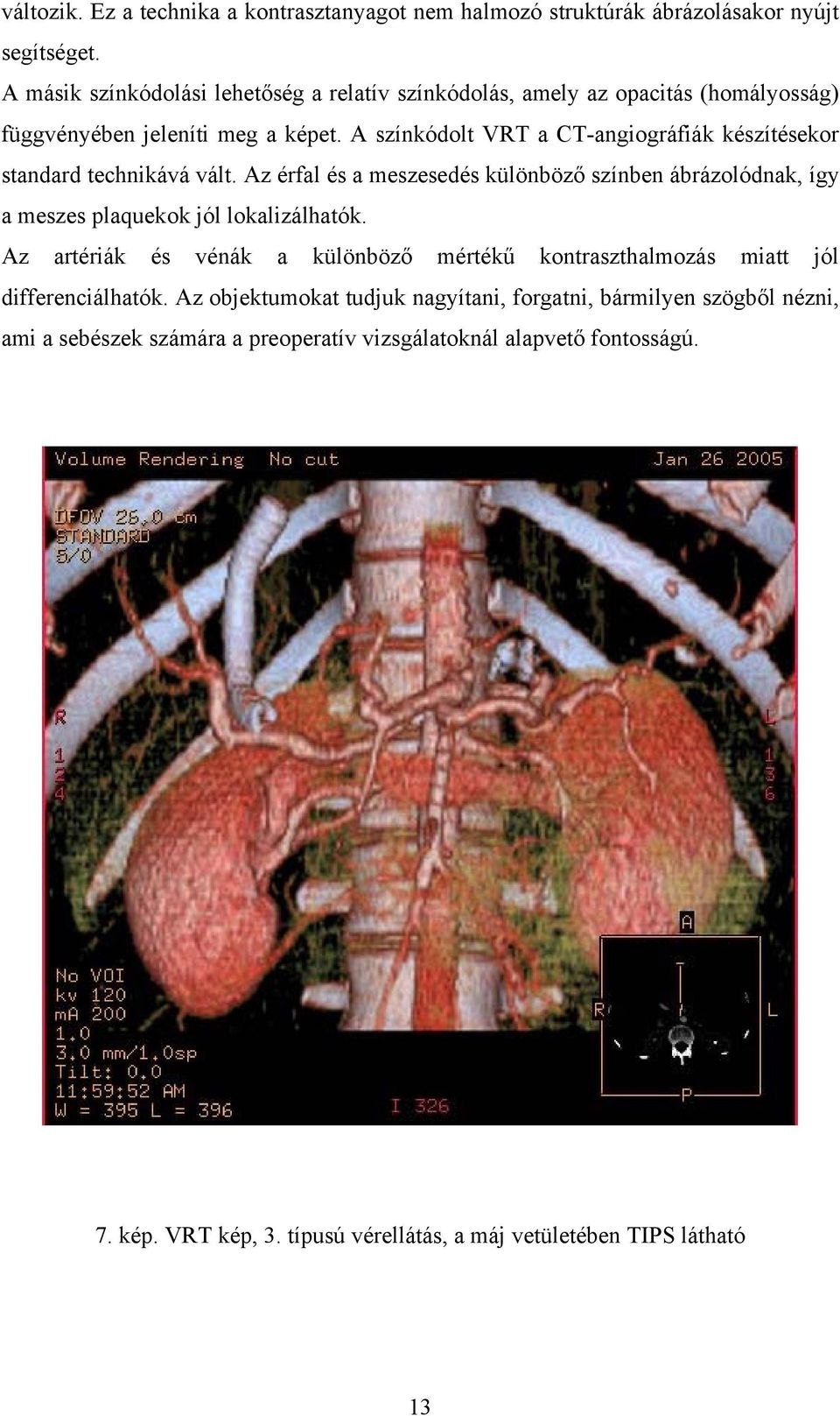 A színkódolt VRT a CT-angiográfiák készítésekor standard technikává vált. Az érfal és a meszesedés különböző színben ábrázolódnak, így a meszes plaquekok jól lokalizálhatók.