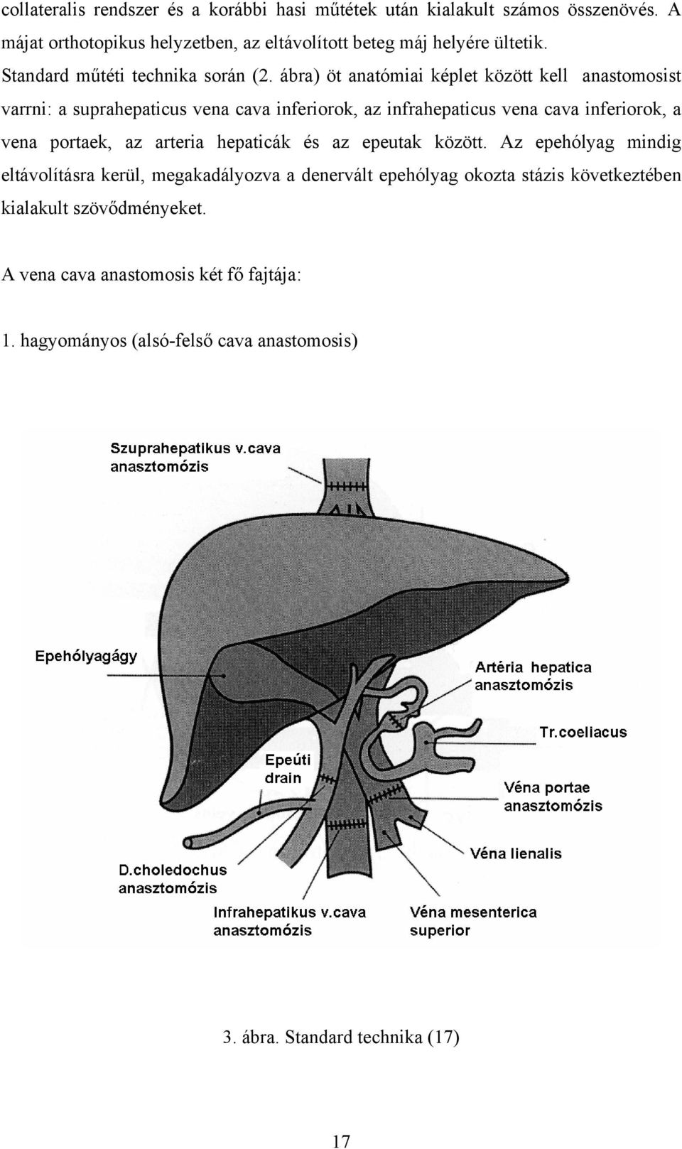 ábra) öt anatómiai képlet között kell anastomosist varrni: a suprahepaticus vena cava inferiorok, az infrahepaticus vena cava inferiorok, a vena portaek, az