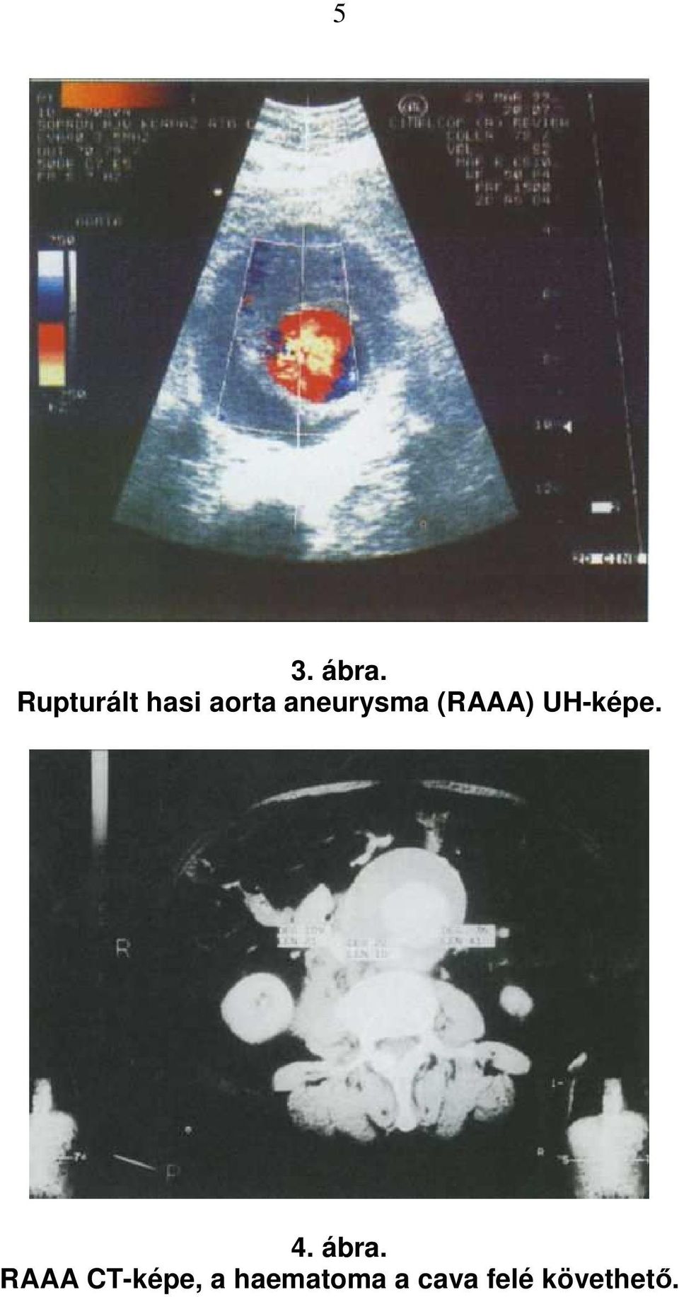 aneurysma (RAAA) UH-képe. 4.