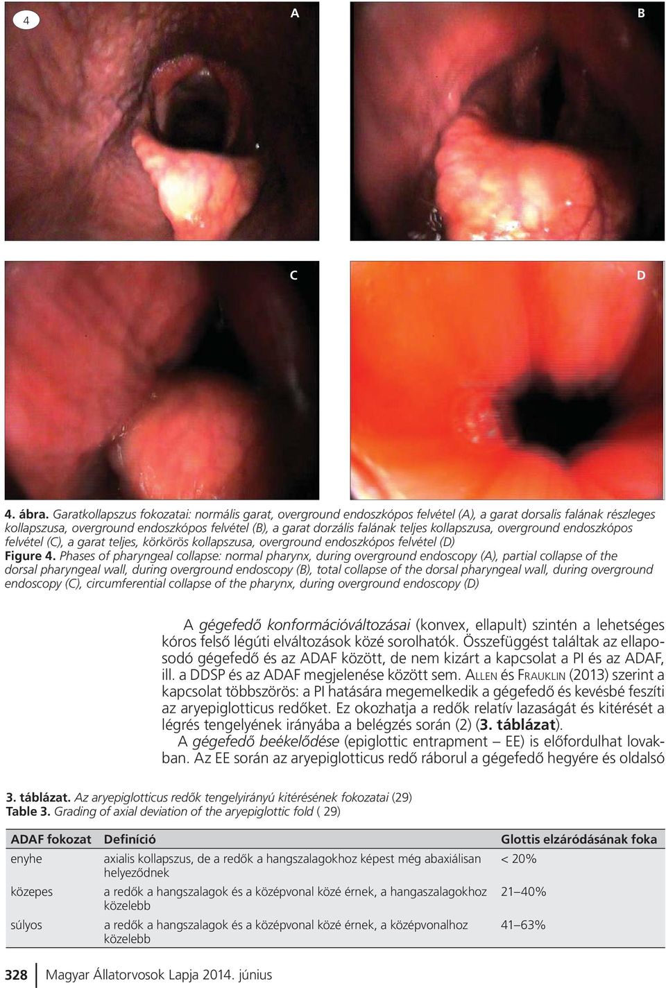 kollapszusa, overground endoszkópos felvétel (C), a garat teljes, körkörös kollapszusa, overground endoszkópos felvétel (D) Figure 4.